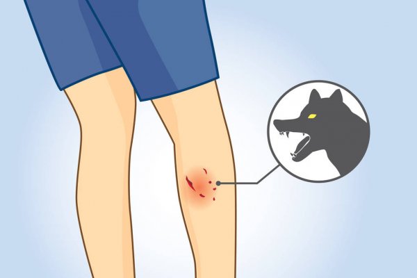 Injuries from dog bites